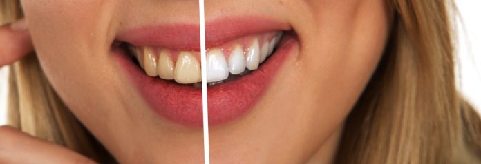 Know best home remedies to whiten teeth naturally